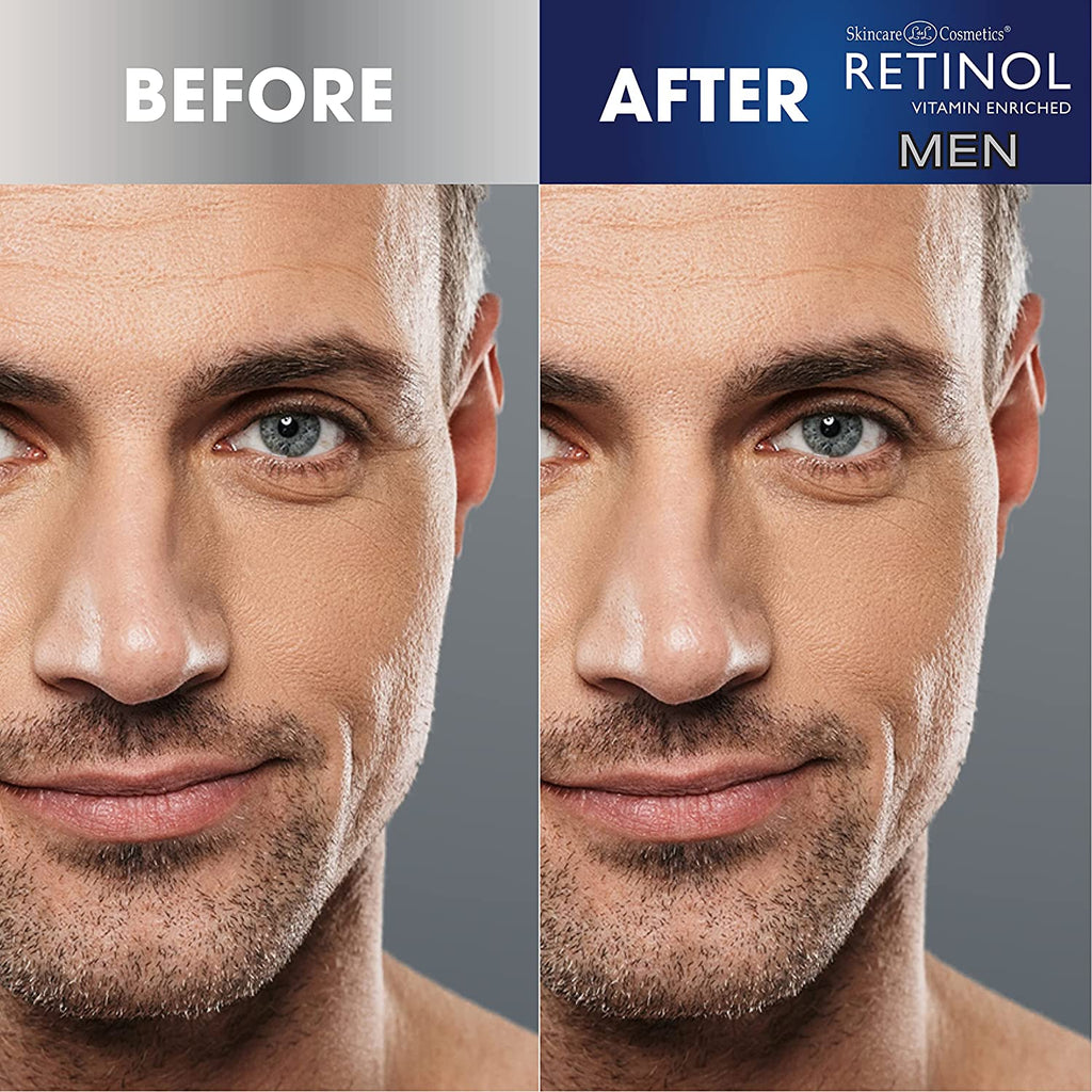 Men's Blackhead Remover - Retinol Treatment